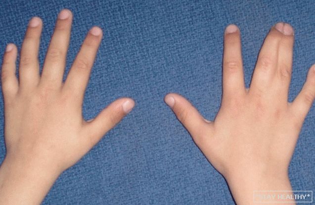 Што значи прицврстување на прстите - синдикалнопрсти и раце